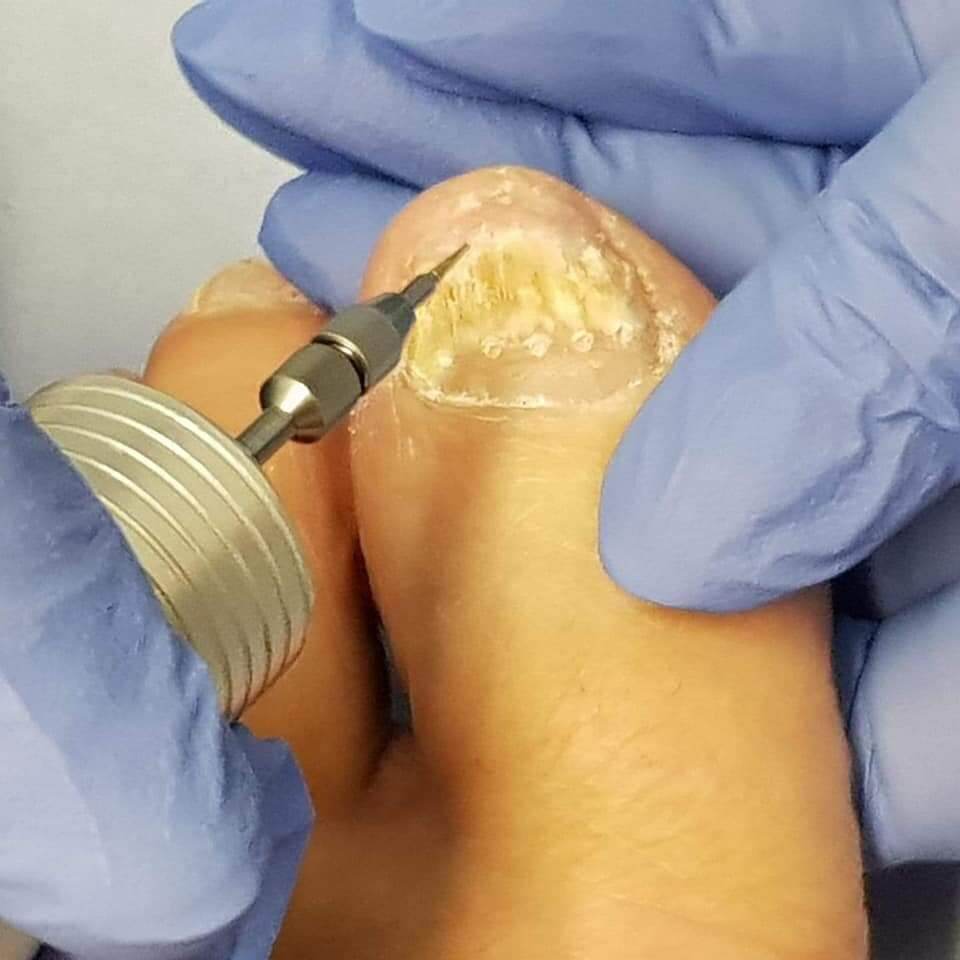 Fungal nail infections the facts Active Podiatry