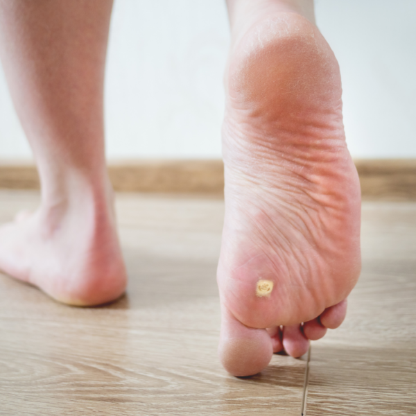 How Can I Get Rid Of My Stubborn Verrucas? Active Podiatry
