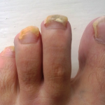A patient with a fungal toe nail problem