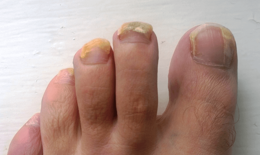 Causes and Treatments of Toenail Fungus | LifeMD