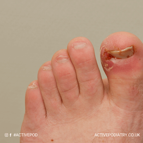 ingrown toe nail (1)