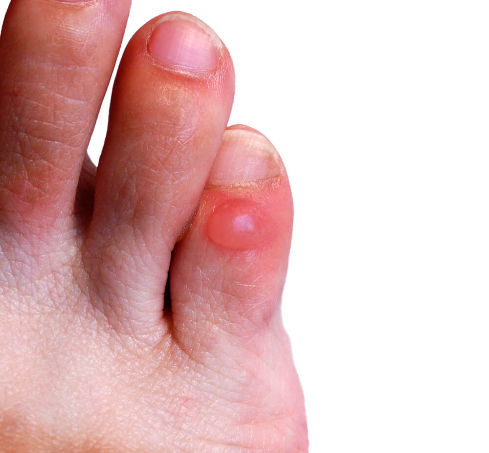 How To Fix Painful Blisters Active Podiatry