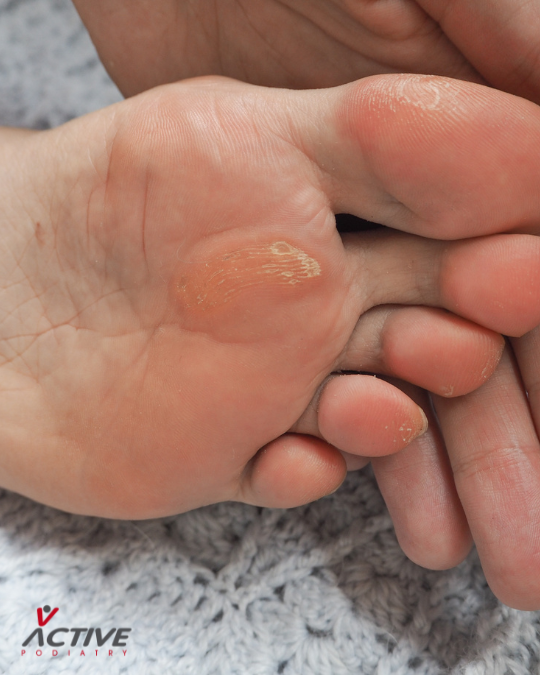 Corn bottom of foot Corn bottom of foot