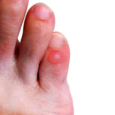 Blister on a toe